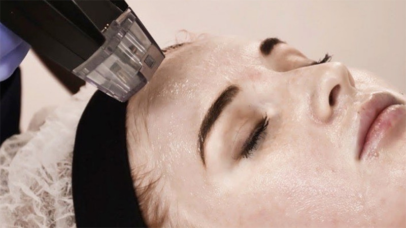 Morpheus8 for Wrinkle Treatment