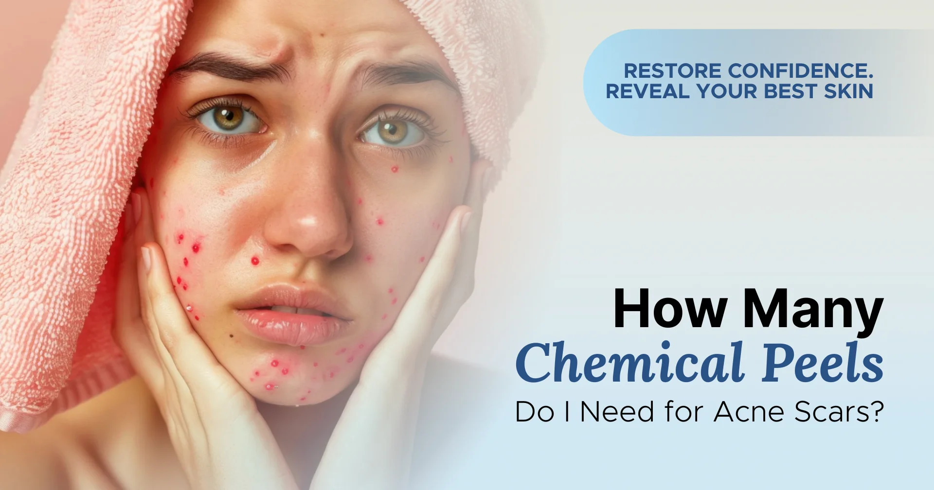 How Many Chemical Peels Do I Need for Acne Scars