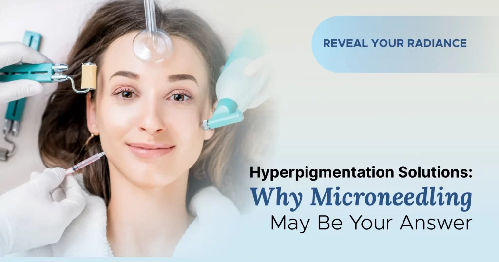 Hyperpigmentation Solutions Why Microneedling May Be Your Answer