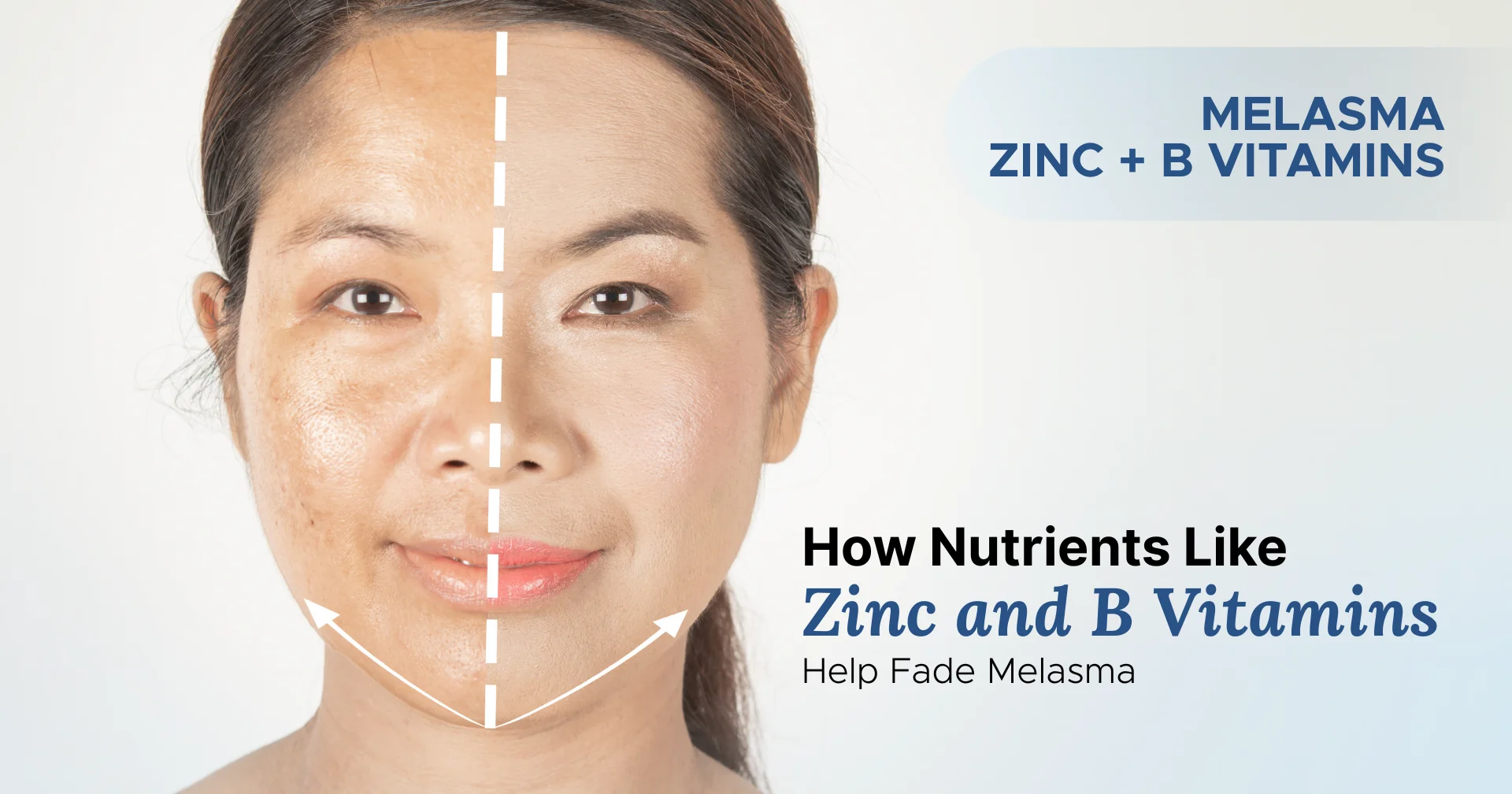 How Nutrients Like Zinc and B Vitamins Help Fade Melasma