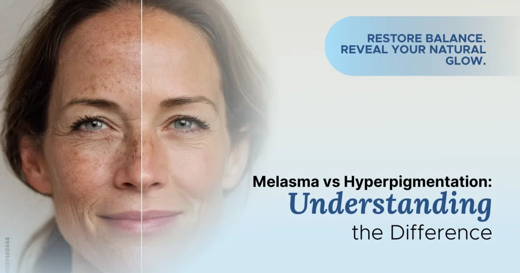 Melasma vs Hyperpigmentation Understanding the Difference