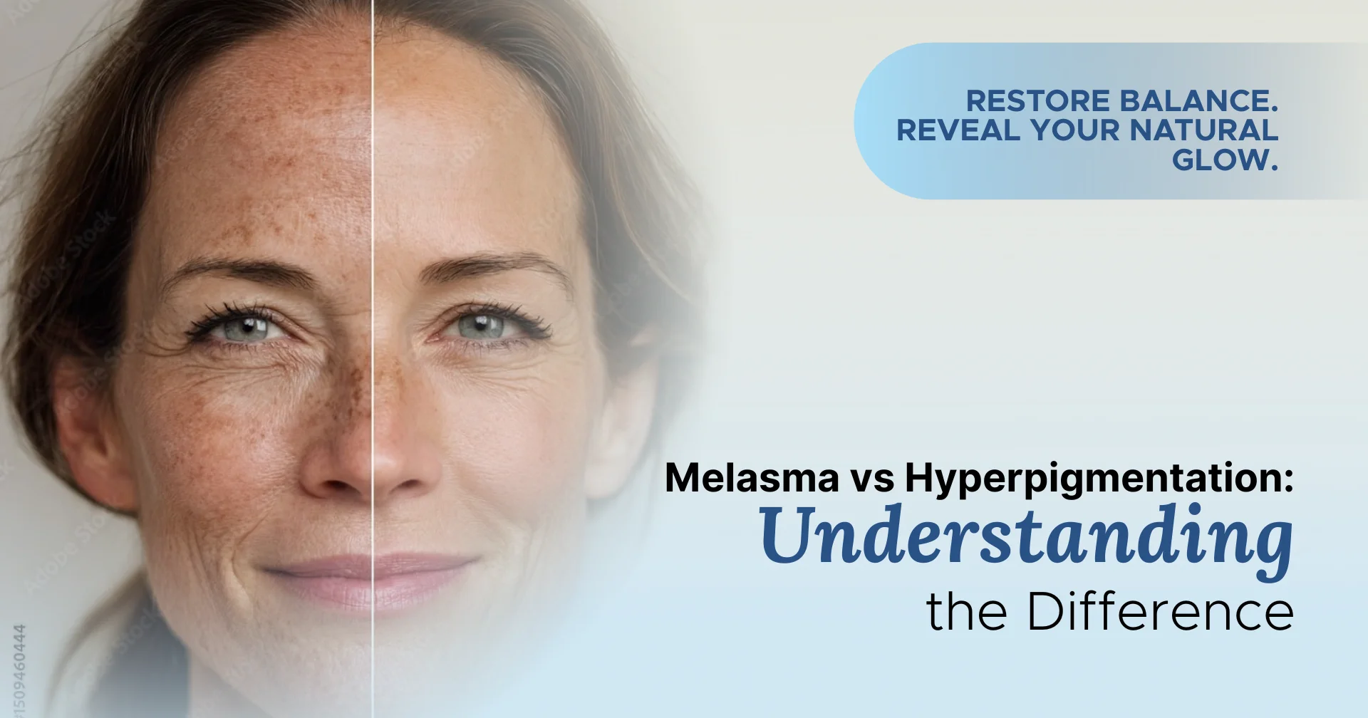 Melasma vs Hyperpigmentation Understanding the Difference