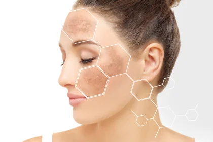 What is melasma