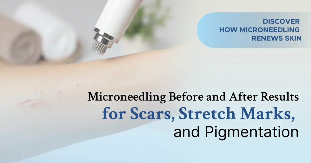 Microneedling Before and After Results for Scars, Stretch Marks, and Pigmentation