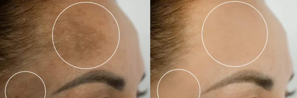 microneedling-for-pigmentation